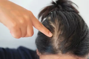 Key active ingredients found in effective hair loss serums