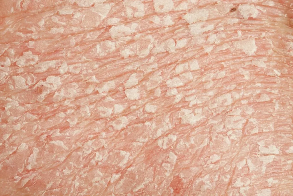 Is Psoriasis Curable? Incredible Big Truth