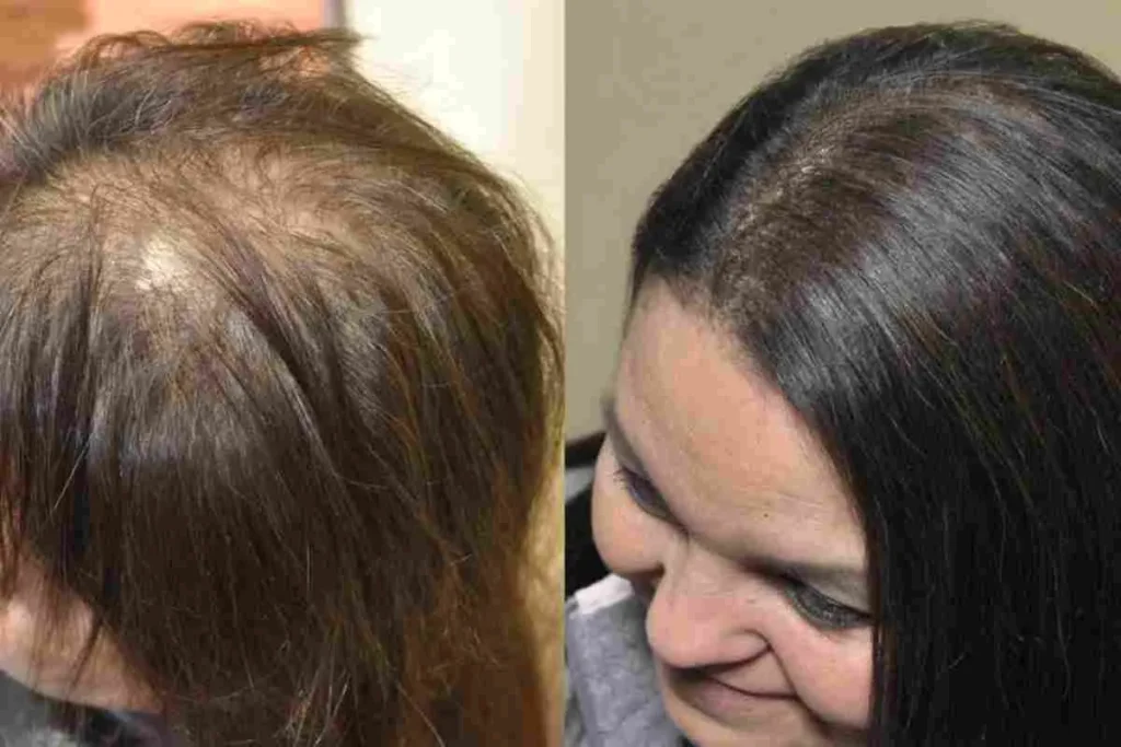 Hair Supplements For Women: Amazing Win