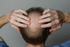 Common alopecia types and their patterns