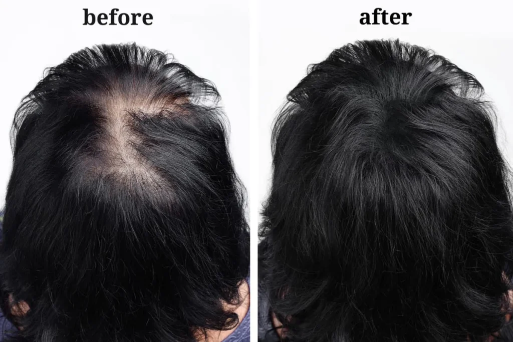 Hair Growing Back After Chemo: Incredible Fix