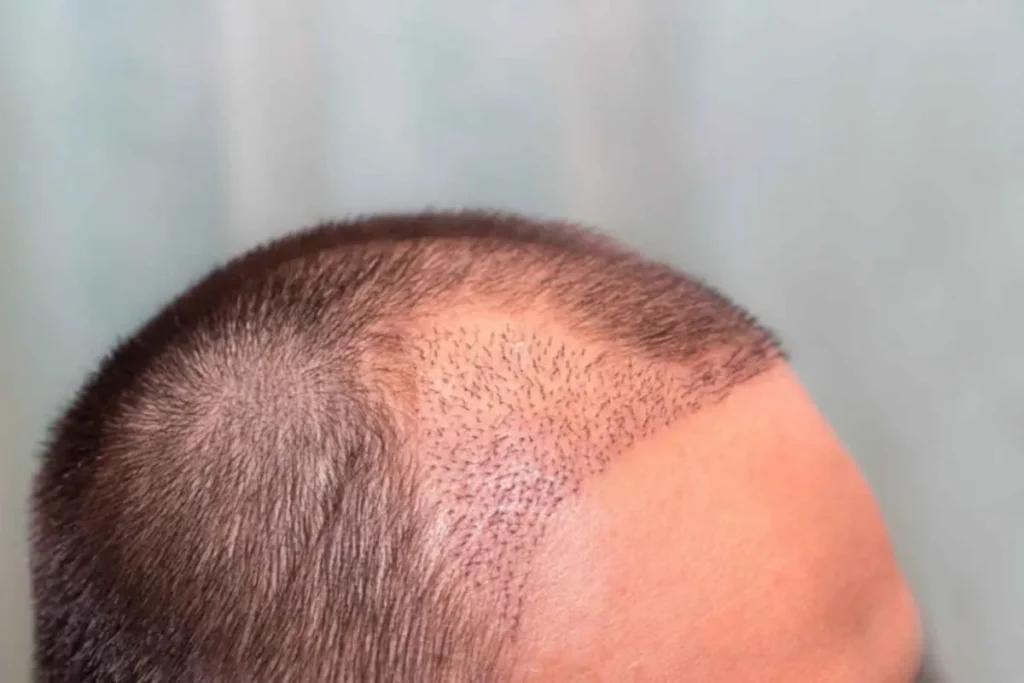 Do Hair Transplants Last Forever? Big Fact
