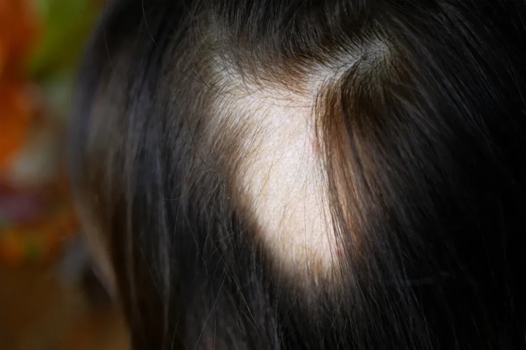 Alopecia In Teenager: Crucial Warning Signs