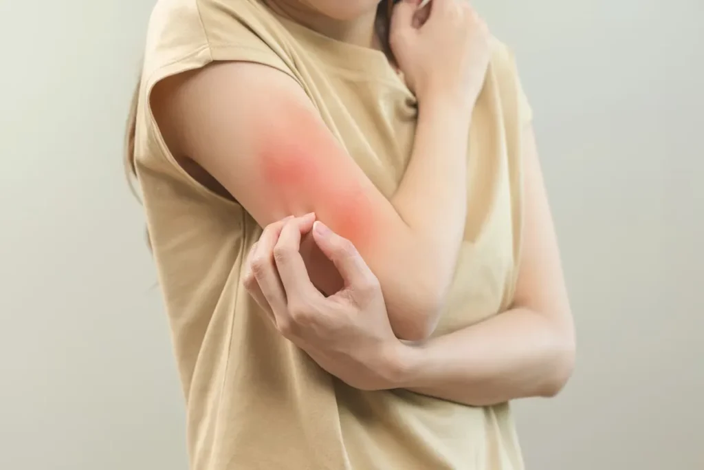 What Stops Itching Fast: 7 Instant Reliefs