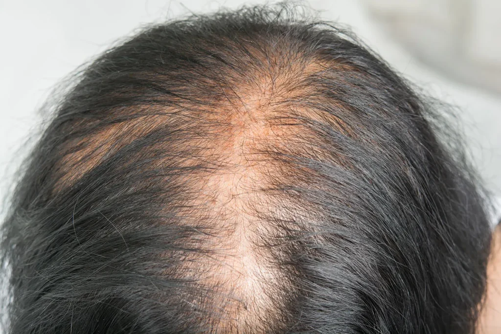Alopecia Red Scalp: 5 Scary Warning Signs