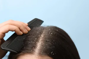 Several factors can trigger both shedding and itching, often working together to worsen the condition.
