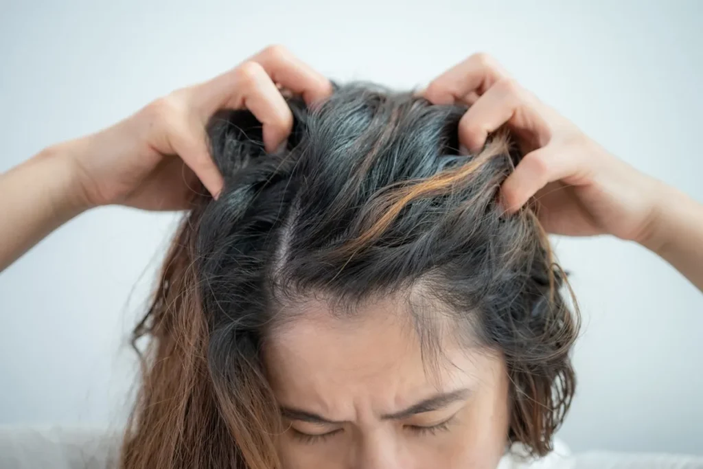 White Scalp: Scary Truth & Amazing Cure