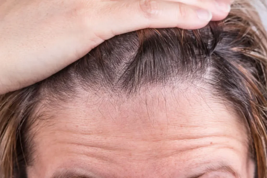 Understanding Hair Loss When Losing Weight