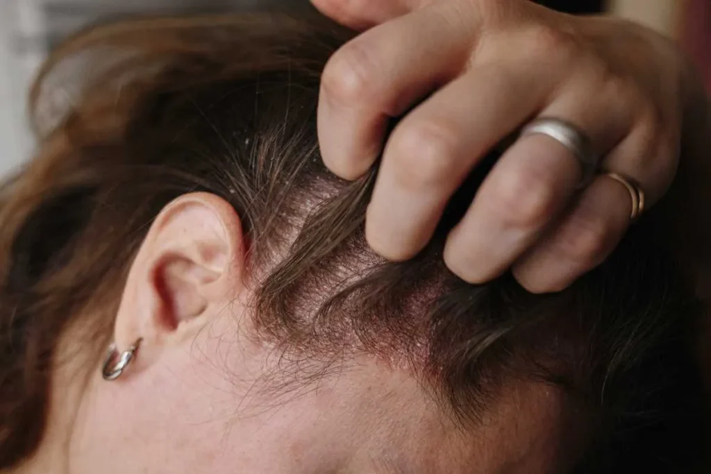 Sore Patches On Scalp: Scary Truth & Fix