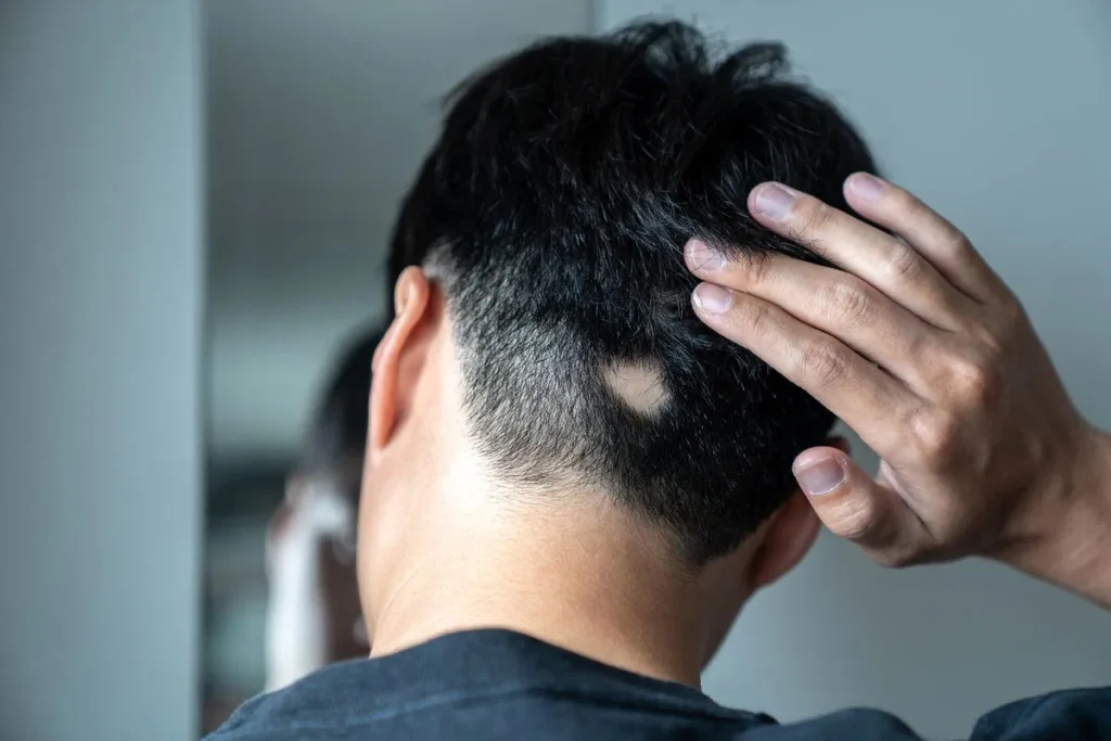Understanding Why Men Experience Balding Rapidly