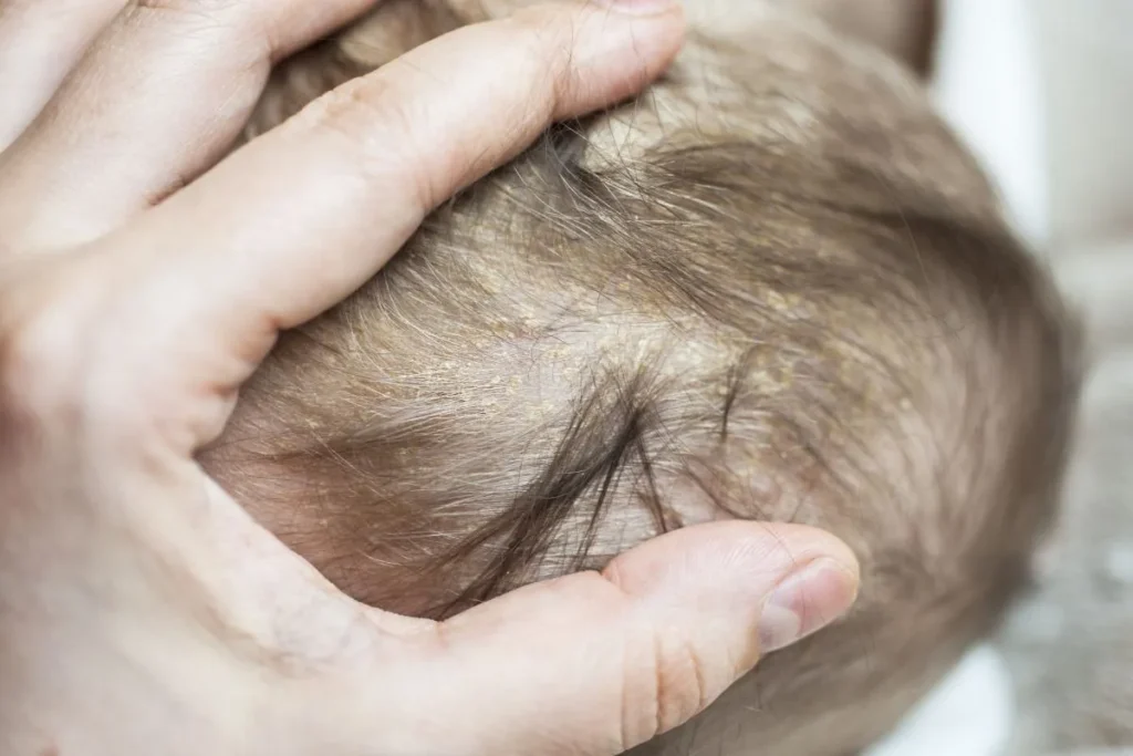 Understanding Seborrheic Dermatitis in Infants