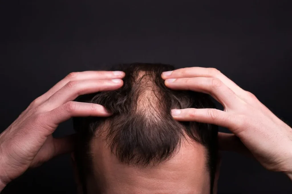 Does Cymbalta Cause Hair Loss? The Big Truth