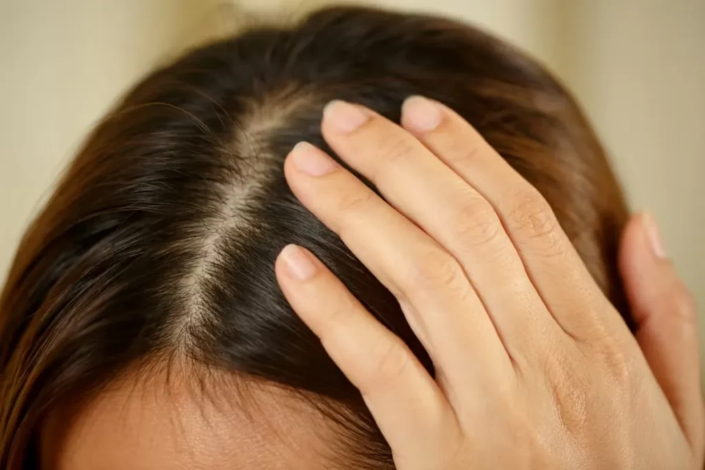 Understanding Dry Scalp: Causes and Symptoms