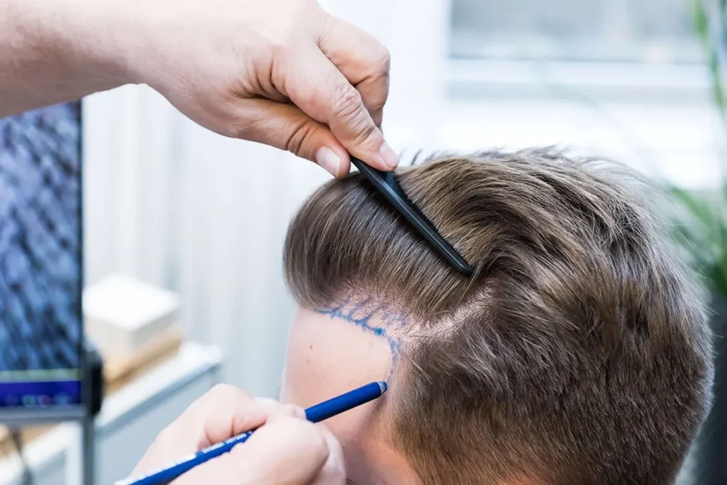 Understanding Male Pattern Baldness