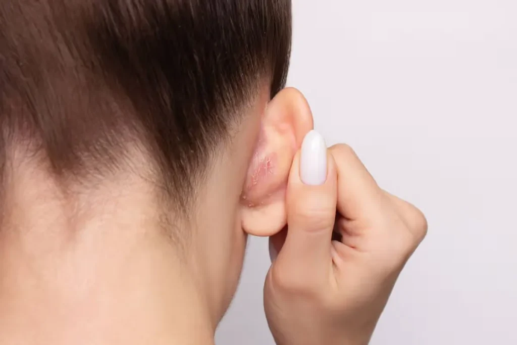 Understanding Seborrheic Dermatitis of the Scalp