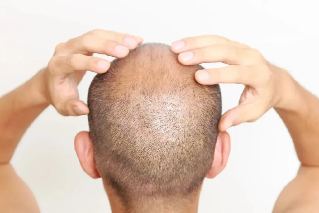 Balding On Sides: Amazing Powerful Cures