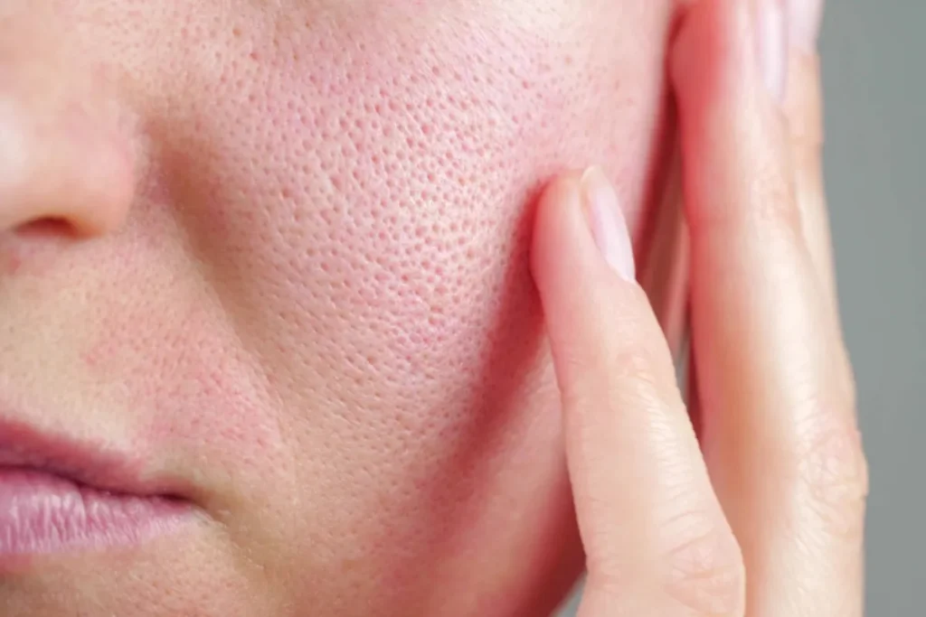 Understanding Seborrheic Dermatitis and Nutrition