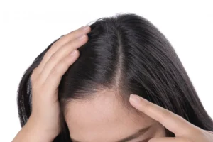 Autoimmune response causing hair loss