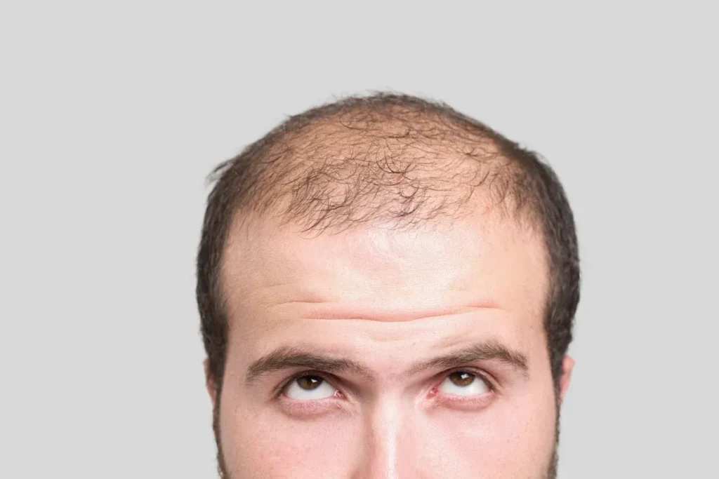 Am I Balding? 5 Scary Warning Signs