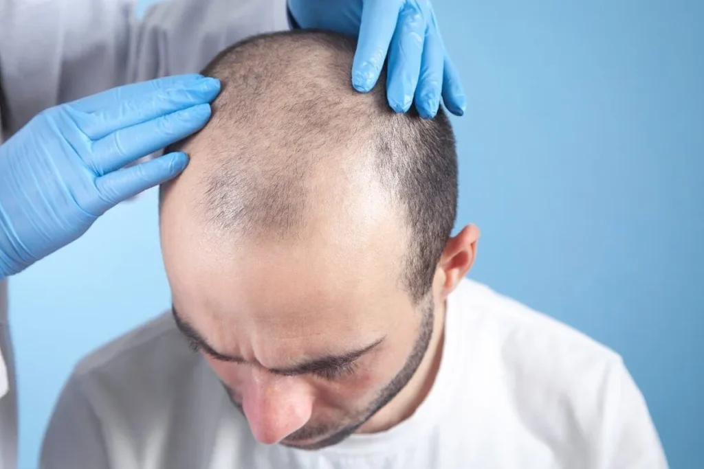 Do Hair Transplants Last Forever? Big Fact