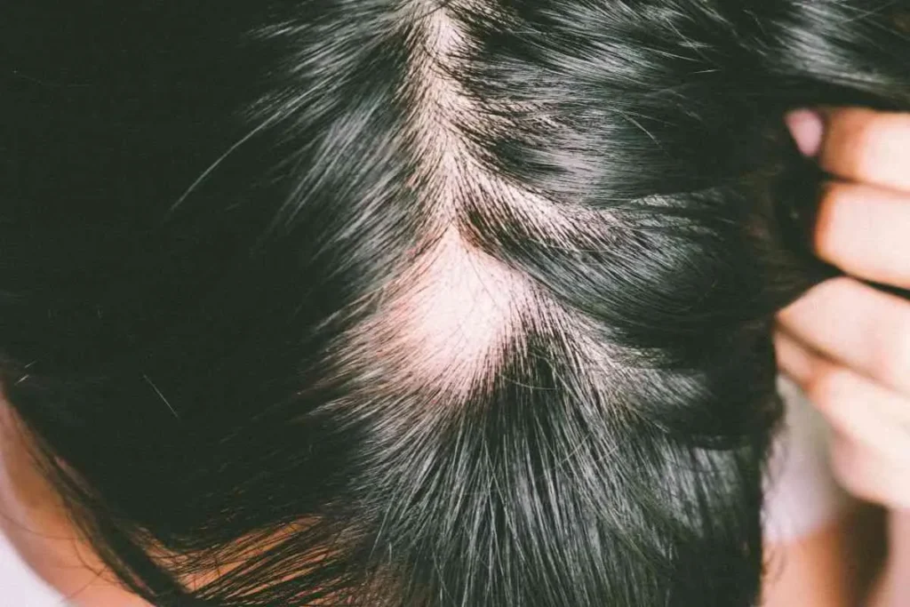 Alopesi Areata'yı Anlamak