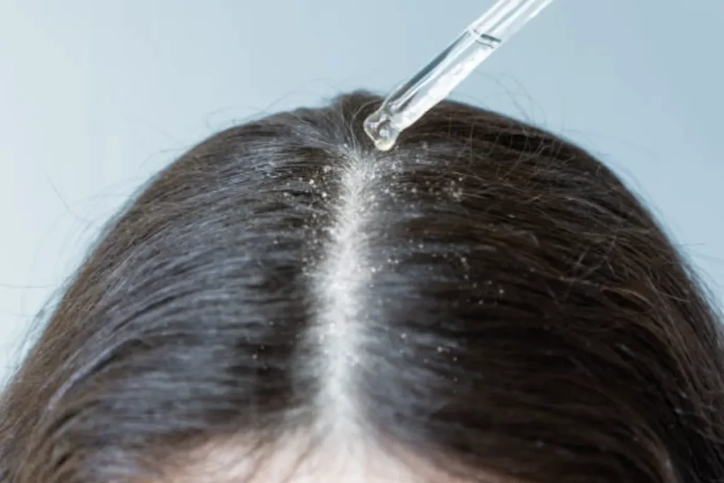 The Benefits of Apple Cider for Scalp Itch