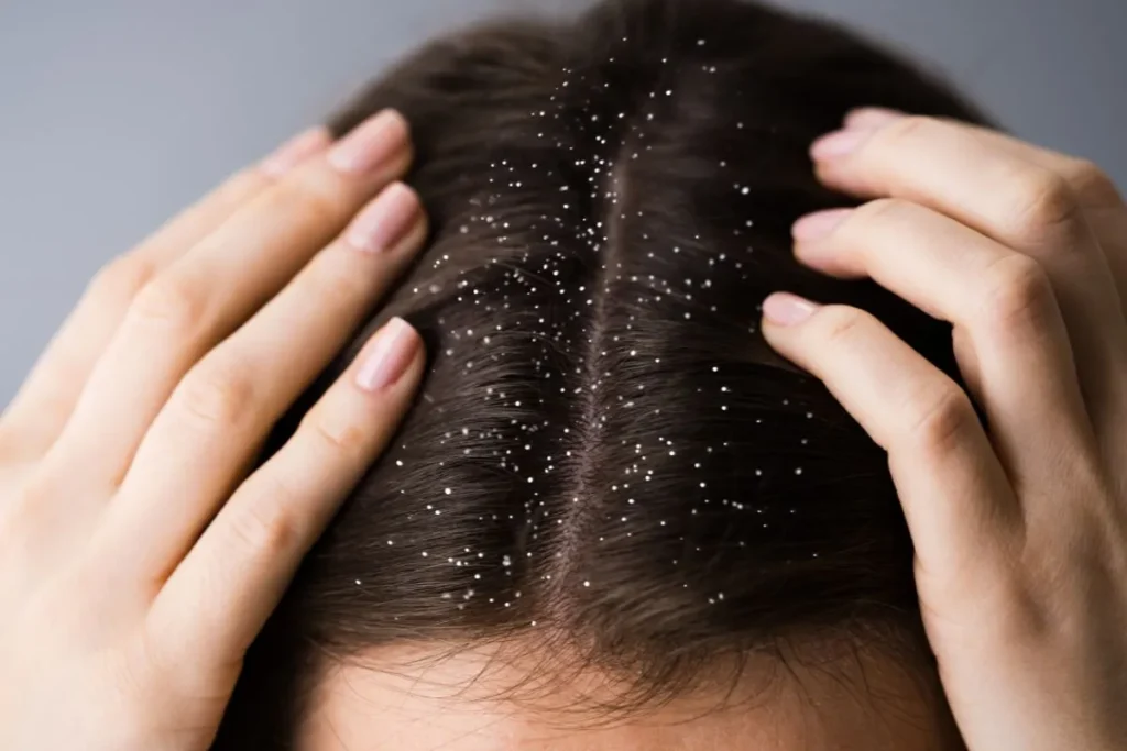 Understanding the Science Behind Dandruff