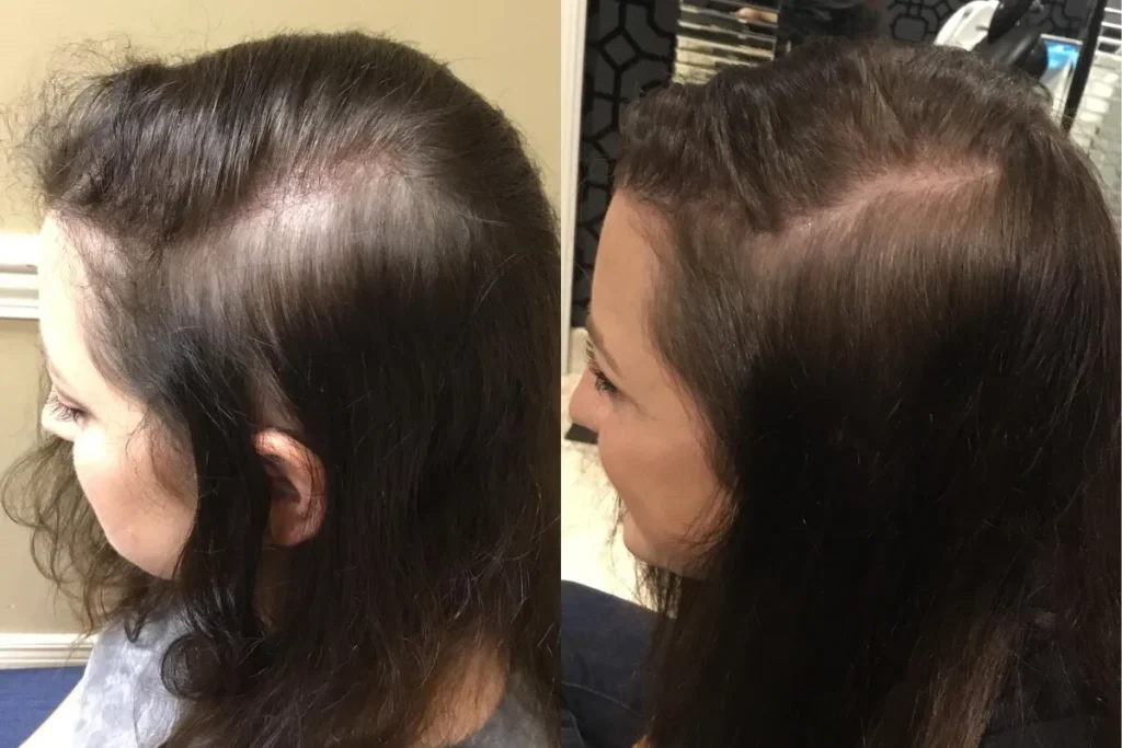 Why Is My Hair Growing Back While On Chemo?