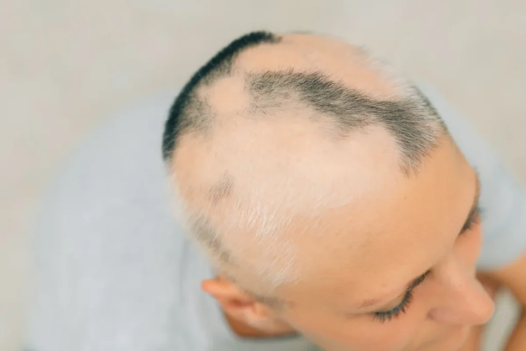 How to Stop Hair Loss from Ozempic: 5 Effective Strategies