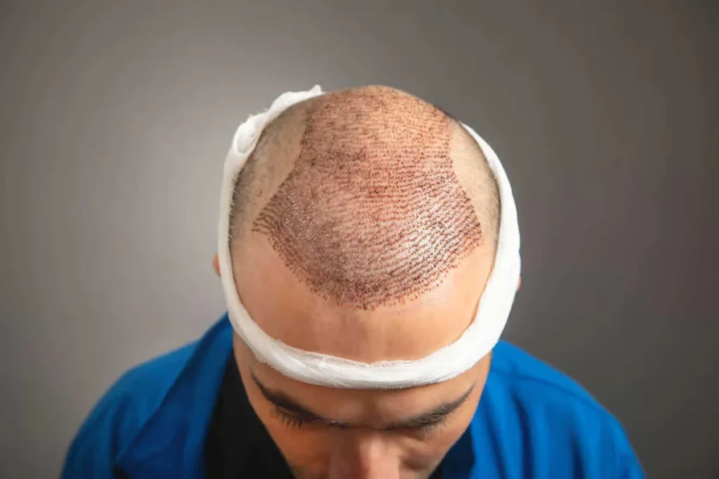 Hair Transplant Growth Timeline: Big Wins