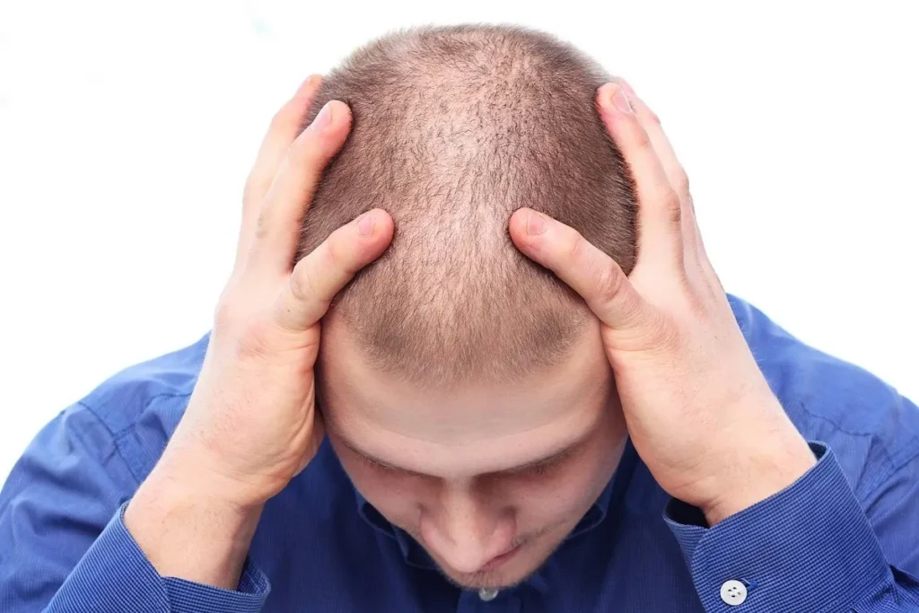 Signs of Balding at 16: What to Look For