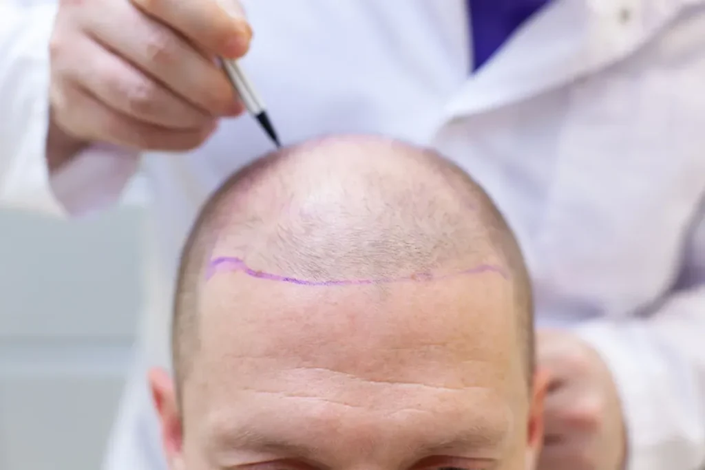 How to Speed Up Hair Transplant Recovery FUE Timeline