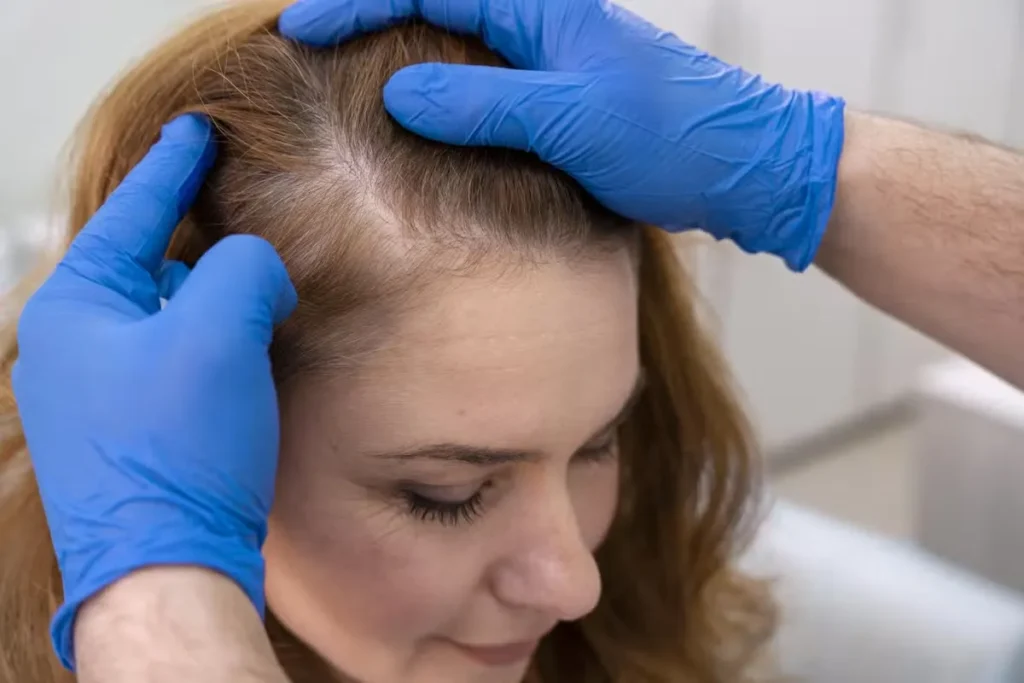 Hair Restoration for Women: Available Techniques