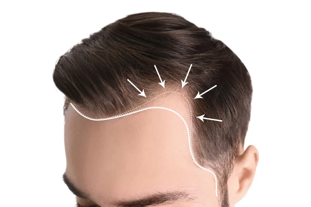 Normal Hairline: Discover Amazing Perfect Signs