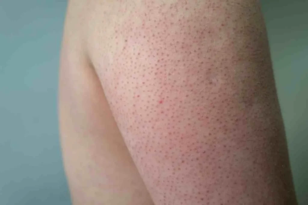 What Causes Cradle Cap in Adults