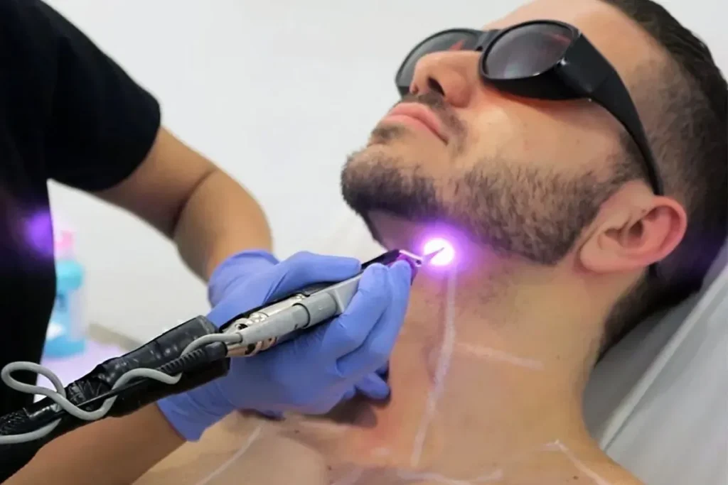 How Many Treatments For Laser Hair Removal?