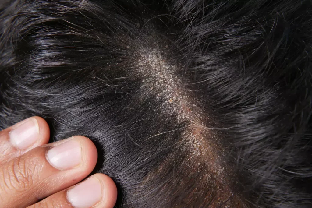 The Connection Between Seborrhoeic Dermatitis and Hair Loss