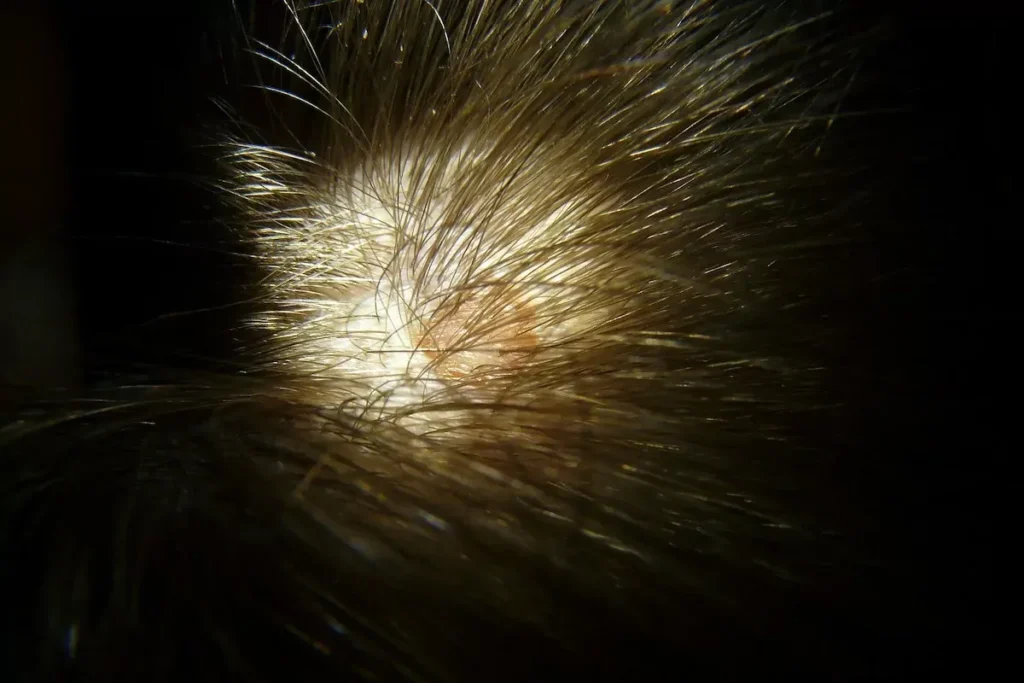 Is Psoriasis Curable? Incredible Big Truth