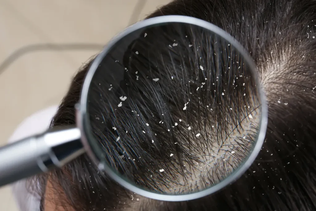 Dandruff Vs Dry Scalp: Scary Truth Fix