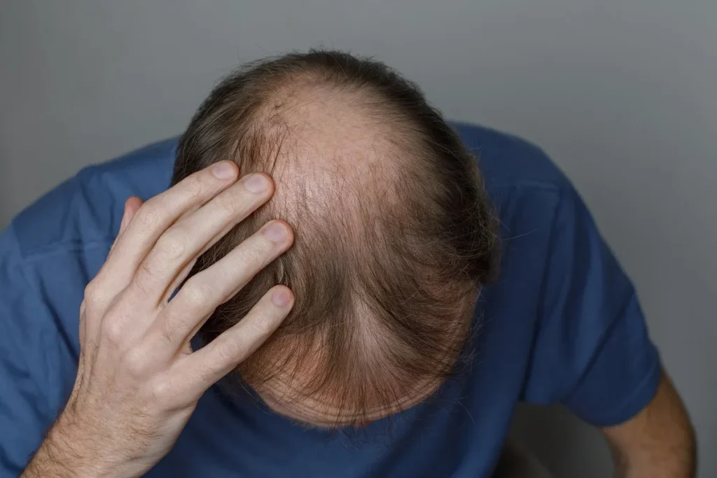Am I Balding? 5 Scary Warning Signs