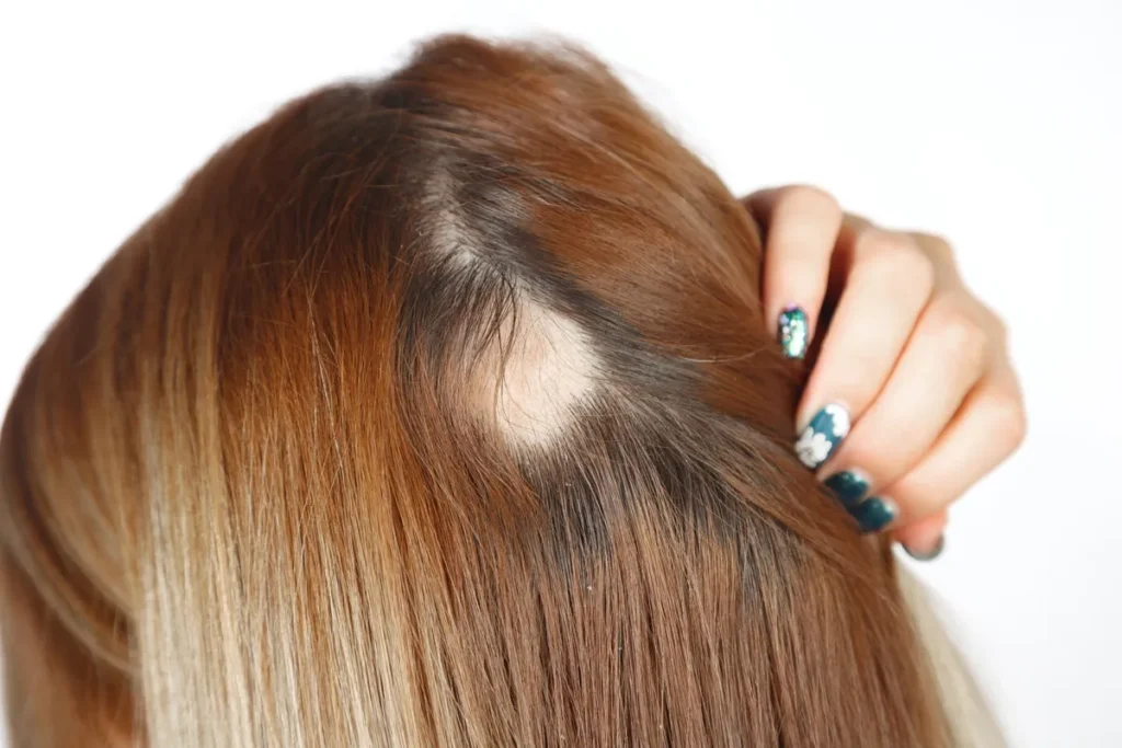 5 Proven Methods to Regrow Hair on Bald Spots