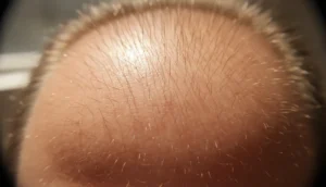 Hair follicle structure with telogen bulb highlighted